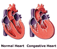 del CUORE Heart failure, also called congestive heart failure (CHF), is a disorder in