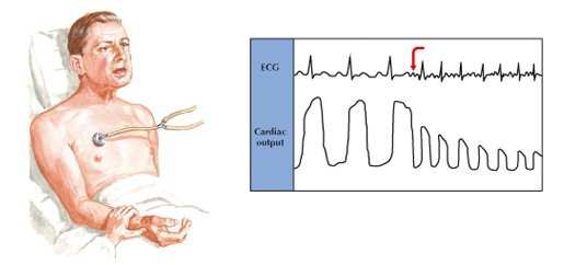 POLVERI SOTTILI E RISCHIO DI INFARTO Nelle giornate più inquinate, il rischio di infarto aumenta del 5%. G.Di Pasquale 37 Congresso Anmco.