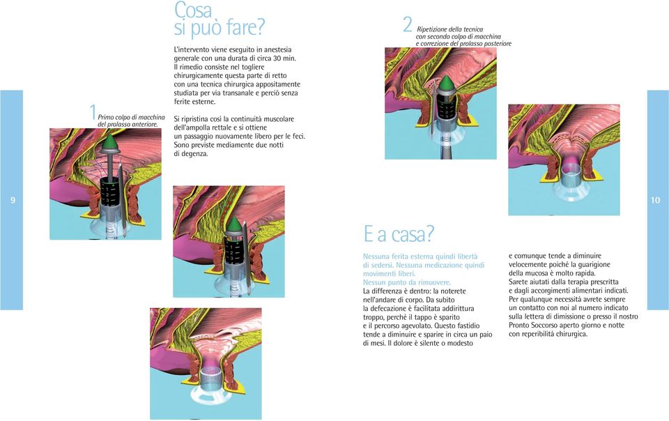 2 Ripetizione della tecnica con secondo colpo di macchina e correzione del prolasso posteriore 1Primo colpo di macchina del prolasso anteriore.