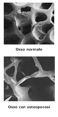 Cos e l osteoporosi Patologia scheletrica caratterizzata da compromissione della resistenza ossea con conseguente aumento della fragilità