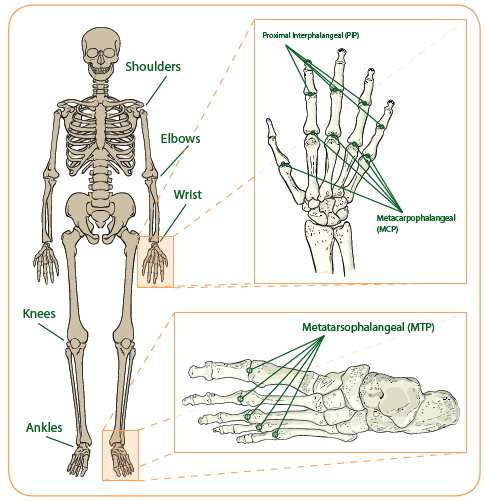 Caratteristiche generali dell artrite reumatoide (AR) Patologia autoimmune delle articolazioni, cronica, sistemica, solitamente simmetrica e poliarticolare, caratterizzata da infiammazione della