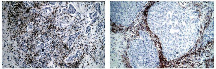 CD3 + T LYMPHOCYTE LOCALIZATION IN TUMORS