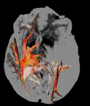 La valutazione in RM della diffusione protonica in vivo è iniziata intorno agli anni 90 con studi dell