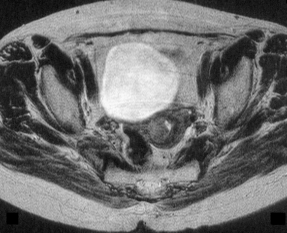 Addome - Pelvi Utero Ca endometrio