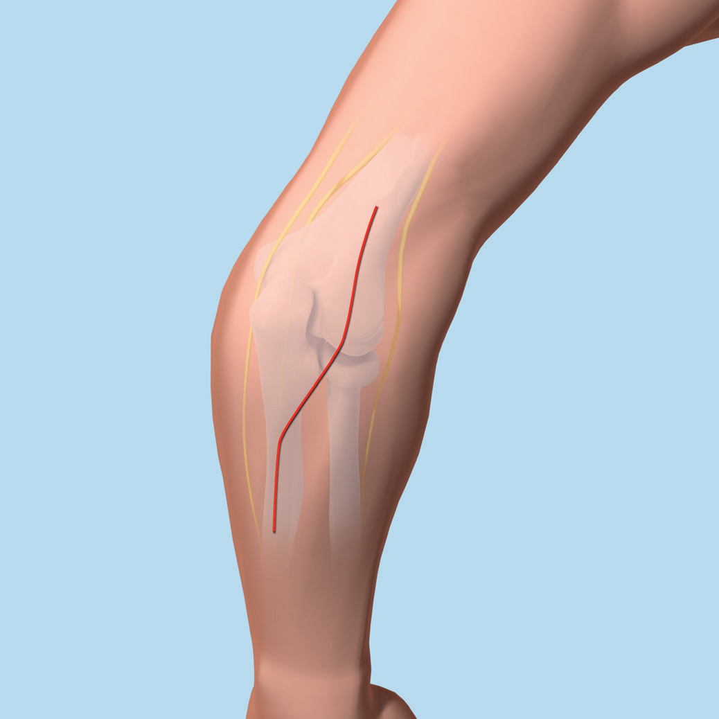 Preparazione e approccio 3 Approccio Effettuare un incisione che decorra posteriormente dalla zona sopracondilare fino a un punto che si trova a 4 o 5 cm distalmente alla frattura.