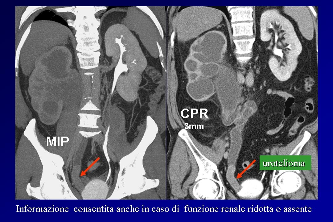 Abbiamo un ottima rappresentazione delle vie urinarie, con possibilità di studiare il parenchima e gli altri organi addominali, con immagini coronali di qualità non inferiore a quelle assiali