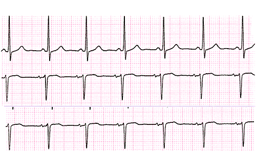 L elettrocardiogramma Il funzionamento del cuore genera delle piccole differenze di potenziale tra i diversi punti del corpo umano.