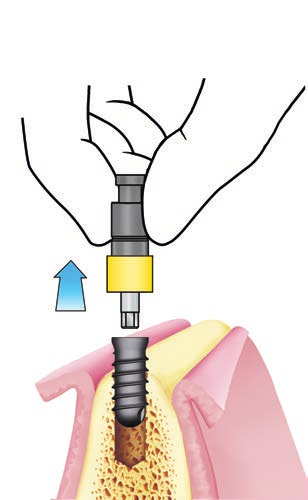 SISTEMA IMPLANTARE EXACONE LEONE procedura chirurgica 2.11 Nel caso di utilizzo del cricchetto le forze trasmesse sull impianto e sul corrispondente osso peri-implantare possono diventare eccessive.