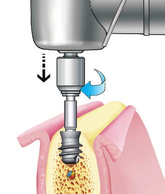 SISTEMA IMPLANTARE EXACONE LEONE procedura chirurgica 4.6 Utilizzando il cricchetto le forze trasmesse sull impianto e sul corrispondente osso peri-implantare possono diventare eccessive.