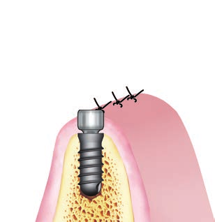 SISTEMA IMPLANTARE EXACONE LEONE procedura chirurgica 9.4 Sutura dei lembi gengivali attorno al tappo.