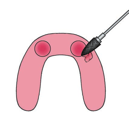 SISTEMA IMPLANTARE EXACONE LEONE procedura chirurgica 11.3 Sutura dei lembi gengivali a totale copertura degli impianti.