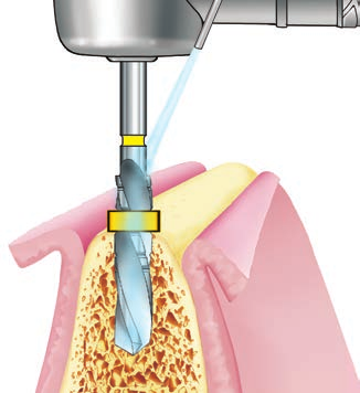 SISTEMA IMPLANTARE EXACONE LEONE procedura chirurgica per impianti Max Stability 1.