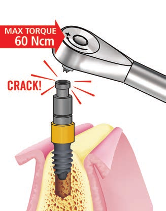 SISTEMA IMPLANTARE EXACONE LEONE procedura chirurgica per impianti Max Stability 2.8 Inserimento dell impianto con il motore da implantologia.