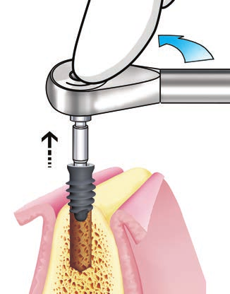 SISTEMA IMPLANTARE EXACONE LEONE procedura chirurgica per impianti Max Stability 2.15 In caso di frattura si proceda a rimuovere il carrier. 2.16a Sostituzione con il driver per impianto (Cat.