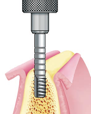 SISTEMA IMPLANTARE EXACONE LEONE procedura chirurgica 1.10 Uso del profondimetro per controllare la profondità del sito implantare appena creato.