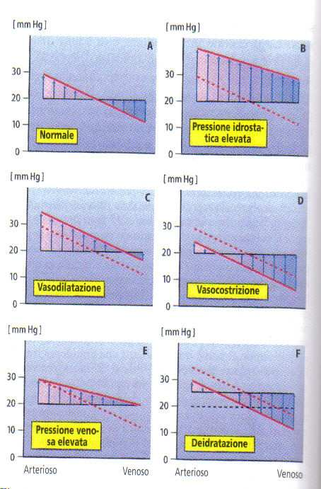 Sbilanciamenti negli scambi capillari Edema: Aumento della pressione arteriosa, vasodilatazione, aumento della pressione venosa, riduzione della