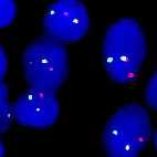 Casistiche non selezionate di DLBCL con n casi >100 Tecnica prevalentemente utilizzata: FISH Single Hit Double Hit SH/DH/TH Myc+ Ref.