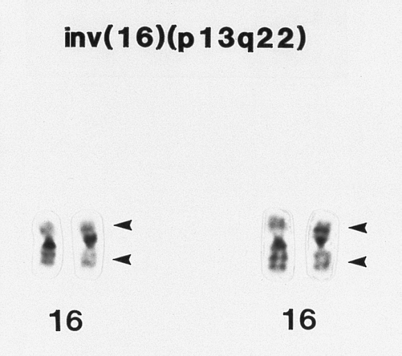 INVERSIONI Cambio nell orientamento di segmenti cromosomici pericentriche Es. 46, XY, inv (1) (p31q43) paracentriche (+ comuni) Es.