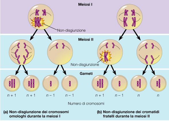 TRASLOCAZIONI ROBERTSONIANE La traslocazione robertsoniana (dal suo scopritore, Robertson) consiste nella fusione di due cromosomi acrocentrici a livello del centromero, dopo perdita delle braccia