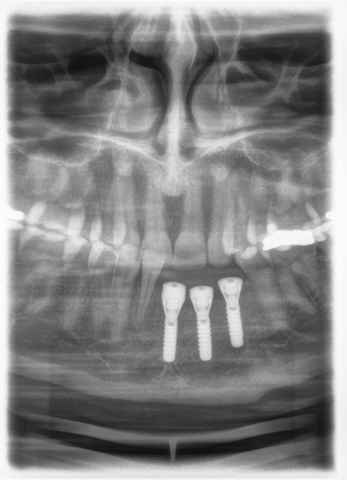 5 Uso Sirona Dental Systems GmbH 5.3 Radiografia panoramica e radiografia bite-wing 5.3.1.