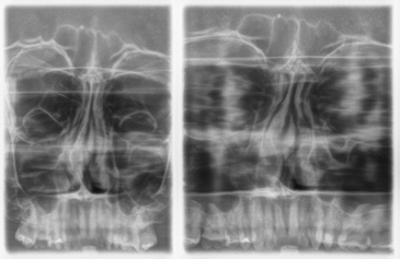Sirona Dental Systems GmbH 5 Uso 5.5 Radiografia dei seni paranasali 5.5 Radiografia dei seni paranasali 5.5.1 Descrizioni del programma 5.5.1.1 S1 Seni paranasali La radiografia fornisce l'immagine dei seni paranasali, ad es.