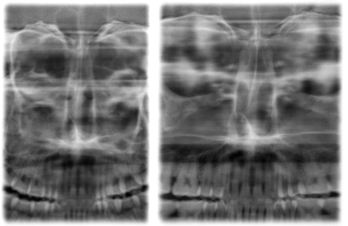 5 Uso Sirona Dental Systems GmbH 5.5 Radiografia dei seni paranasali 5.5.1.3 S3 Seni paranasali, tracciato sezione lineare La radiografia fornisce l'immagine dei seni paranasali, ad es.