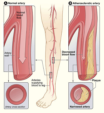 Definizione funzionale dell Arteriopatia Periferica Riduzione di calibro dell