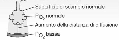 Disturbi nello scambio di O 2 (ipossia ipossica) Cause e tipi di ipossia Ipossia ipossica: bassa P O2 arteriosa Fisiologica: elevata altitudine Ipoventilazione alveolare Riduzione della capacità di