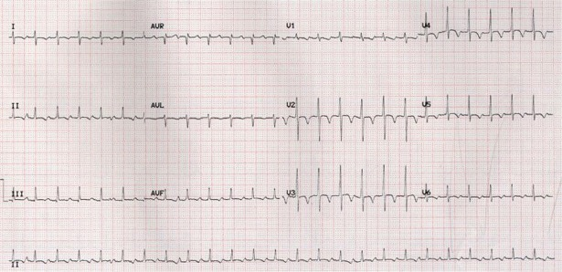 ECOCARDIO: Dilatazione camere cardiache ( LVID 42 mm). Globale riduzione della cinesi ventricolare (SF 24%).