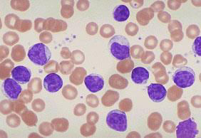 Il conteggio dei globuli bianchi Leucemie: forme tumorali che