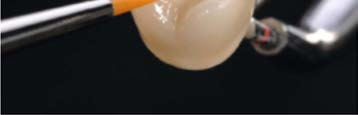 Fig. 12 Applicazione del body stain nell area dentina Fig.