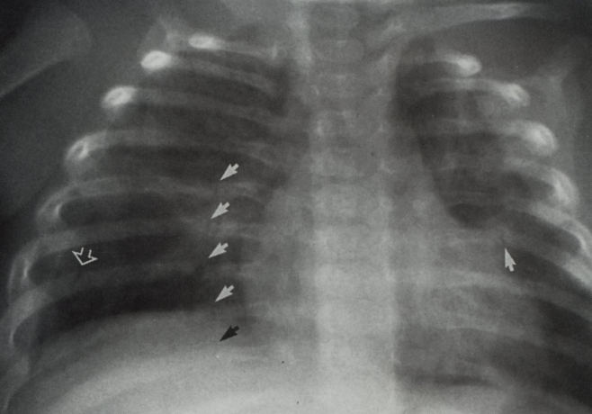 La richiesta appropriata dell esame radiologico Le fratture costali, se non scomposte, sono difficilmente dimostrabili in fase acuta, prima della formazione del callo