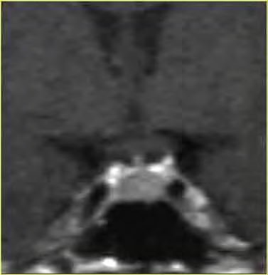 RM dinamica tomogrammi ripetuti, in sequenza rapida durante la somministrazione di mdc in bolo