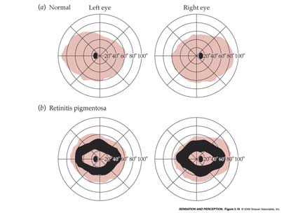 2 The Man Who Could Not See Stars 2 The Fundus: Normal vs.