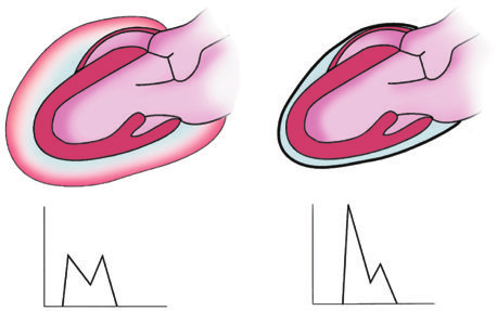 Pericardiopatie Capitolo 10 277 Pre Post 700 cc Figura 10-17 Pericardiocentesi. a sinistra freccia a destra Figura 10-18 Diagnosi differenziale tra tamponamento pericardico e pericardite costrittiva.