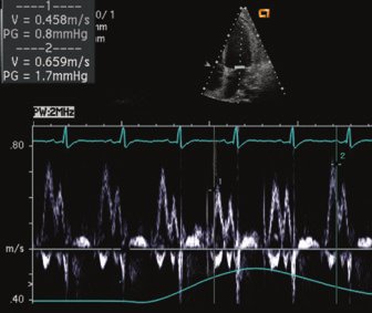 280 Capitolo 10 Pericardiopatie mmhg 25 0 Pericardite costrittiva Doppler venoso epatico Figura 10-23 in un paziente con pericardite costrittiva. a y con l espirazione.