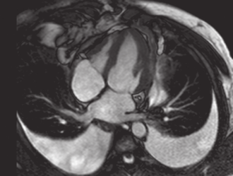 282 Capitolo 10 Pericardiopatie A CP B CP C RCM D RCM Figura 10-25 Velocità longitudinale e velocità di untwisting del nella pericardite costrittiva (CP) e nella cardiomiopatia restrittiva (RCM).