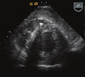 Pericardiopatie Capitolo 10 271 Figura 10-6 Versamento pericardico circonferenziale. - - Versamento pericardico Polmone Ematoma Figura 10-7 Versamento pericardico maligno.