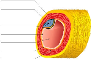 SVILUPPO DELL ATEROSCLEROSI PLACCA ATEROMASICA L aterosclerosi è un processo patologico nel quale il colesterolo, i detriti cellulari ed altre sostanze si accumulano all interno della parete