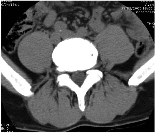 Fig. 2 - Stenosi del canale