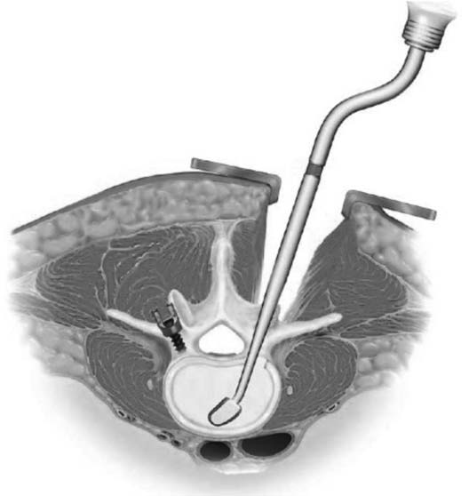 Fig. 3 - Svuotamento del disco per via trans foraminale. Fig.