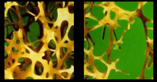 Patologia progressiva dello scheletro caratterizzata da una ridotta massa minerale ossea e deterioramento