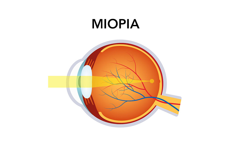 Nel caso dell ipermetropia, causata da una cornea piatta, da un problema al cristallino o da un globo oculare troppo corto, le immagini sono messe a fuoco dietro la retina, rendendo difettosa l
