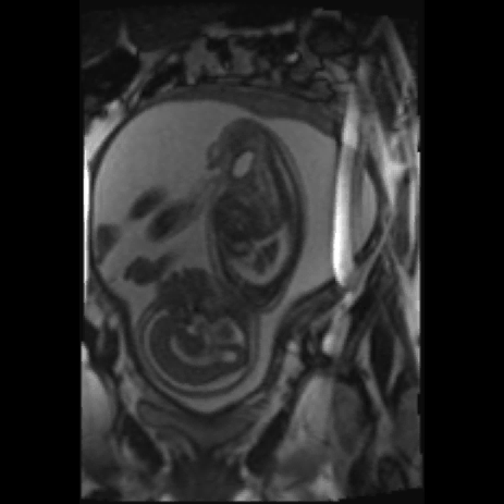 Da gennaio 2008 studiati con ecografia ostetrica/ecocardiografia/rmn fetale oltre 150 feti: GRUPPO A: feti con dislocazione del cuore per patologia polmonare GRUPPO B: feti con sindrome