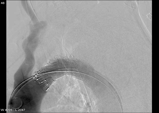 Rilas cio controllato Grazie alla capacità di adattamento di Pro-Form il chirurgo ha a disposizione svariate opzioni per quanto riguarda i siti di fissazione.