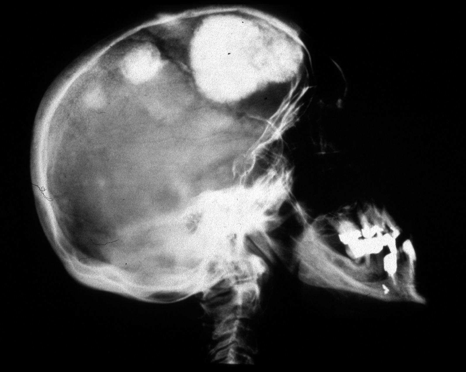 aria-tessuto molle, Radiografia del cranio: ottimo