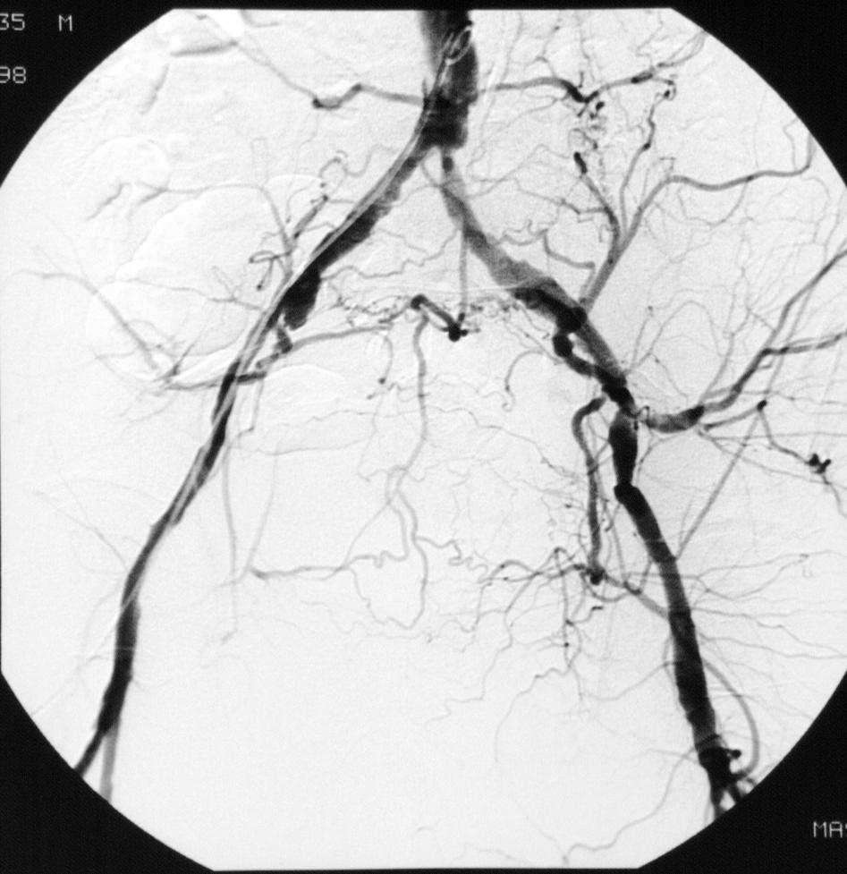 cardiaca, angiografia coronarica