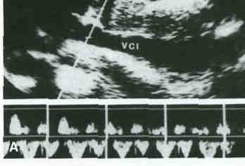 Vena cava inferiore Alterazioni del flusso cavale Ostacolato efflusso da alterata emodinamica del cuore destro Nell'ipertensione polmonare : le variazioni di calibro della vena cava inferiore sono