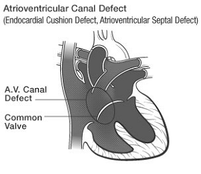 CANALE ATRIO-VENTRICOLARE E un difetto ampio al centro del cuore, a