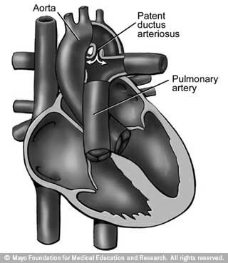 sovraccarico polmonare e cardiaco successivamente sovraccarico del cuore